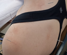 Paraná forma médicos da Atenção Primária para atuar com acupuntura no SUS