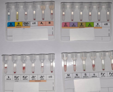 Tratamento especializado ofertado pelo Hemepar amplia qualidade de vida de pacientes com Anemia Falciforme e Talassemia